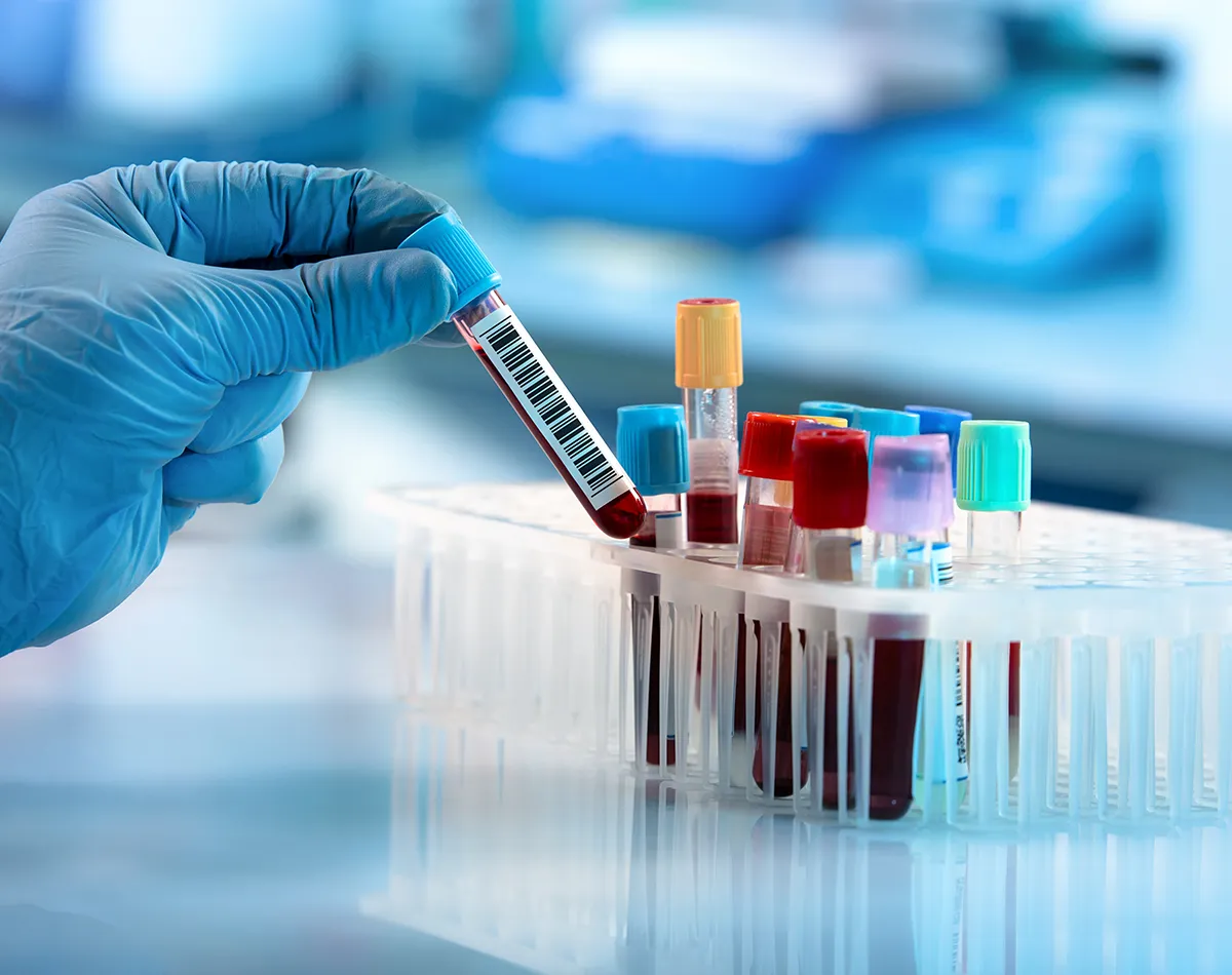 Allergie Bluttest Laboruntersuchung Reagenzgläser in einem Halter, teilsgefüllt mit einer roten Flüssingkeit. Eine Hand im Handschuh hält ein Glas in der Hand