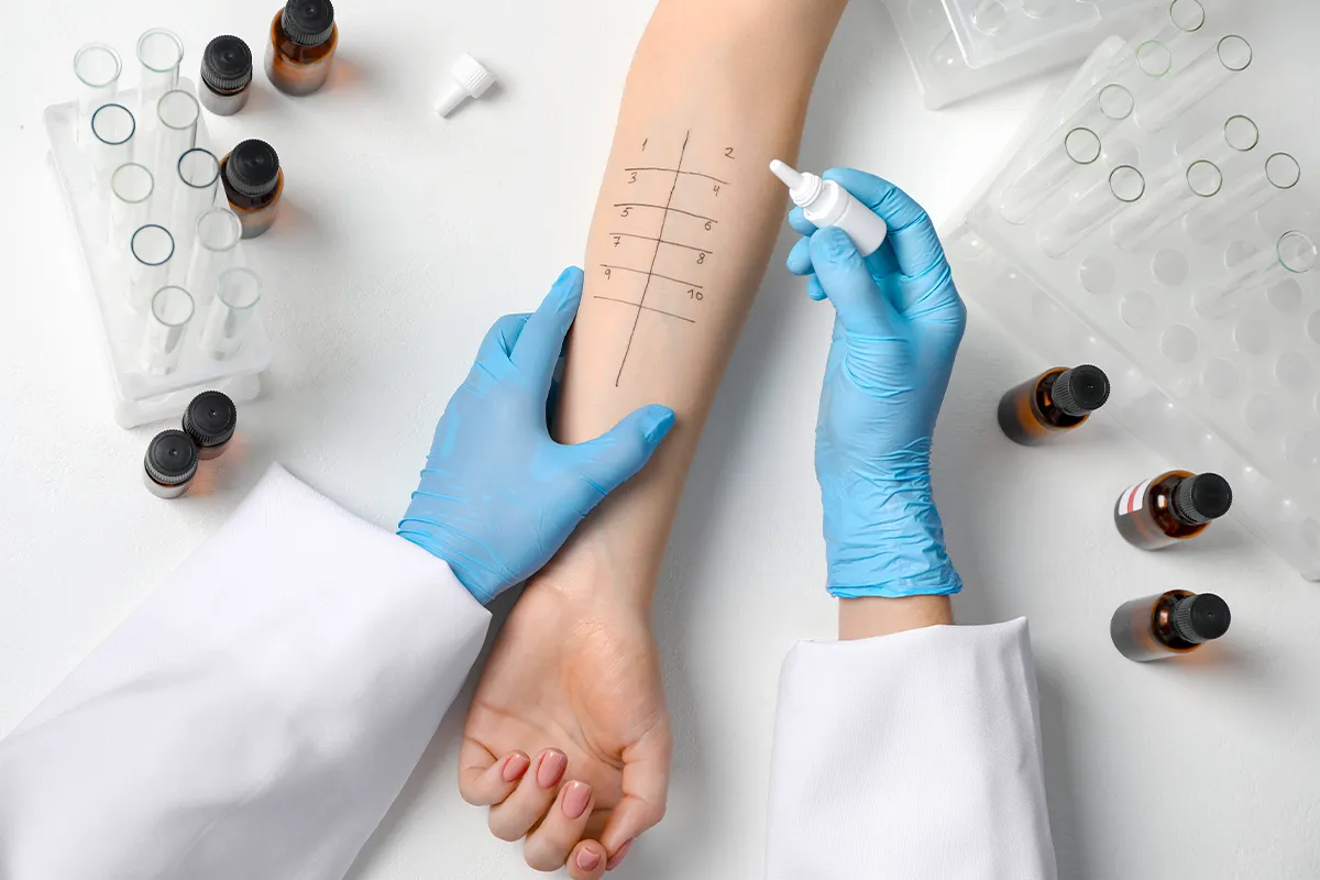 Allergietest Pricktest Diagnose finden An einem Arm wird ein Pricktest druchgeführt. Drum herum sind Reagenzgläser in Haltern