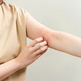 Eine Frau kratzt sich am Armgelenk, welches Ekzeme aufweist